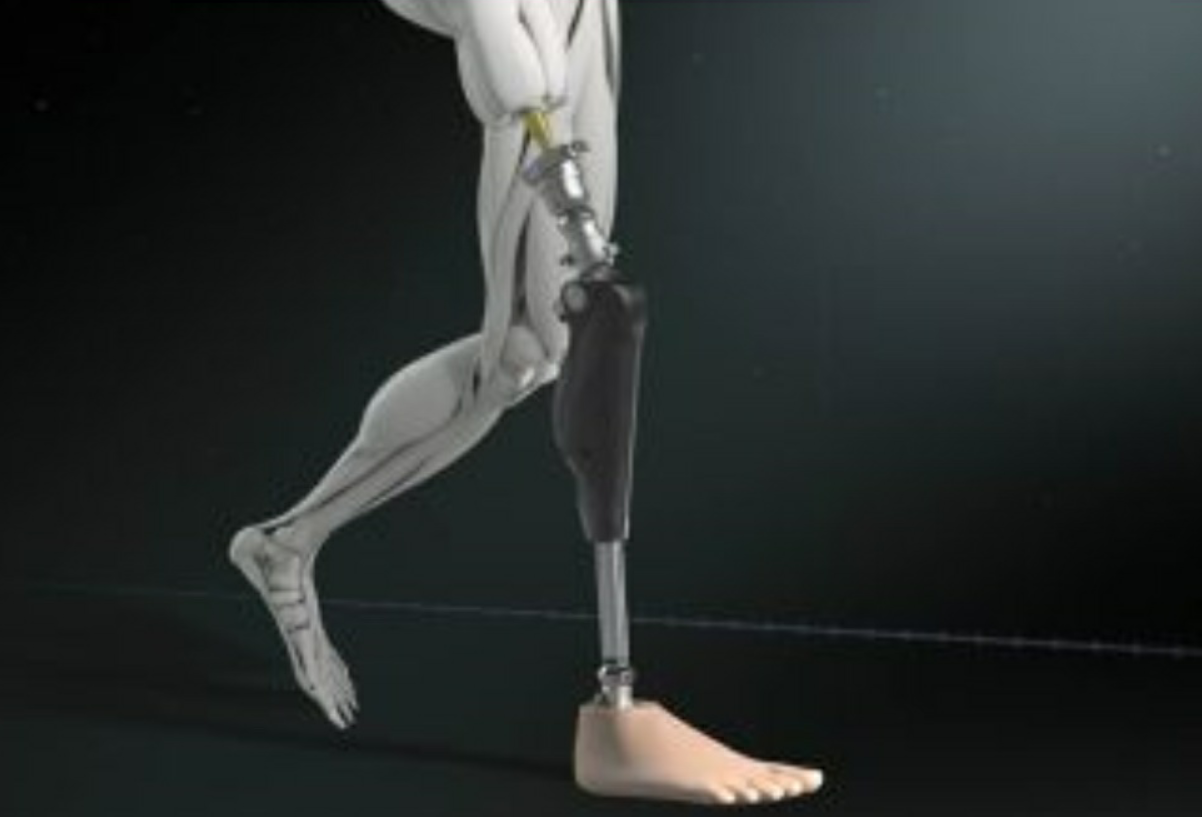 La meratese Permedica porta in Italia una nuova tecnologia che aiuterà le persone amputate