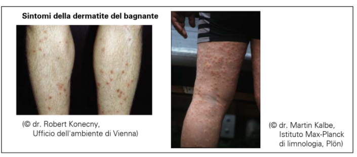 Casi di dermatite da parassiti dopo bagni nel ramo lecchese del Lario e nel lago di Pusiano