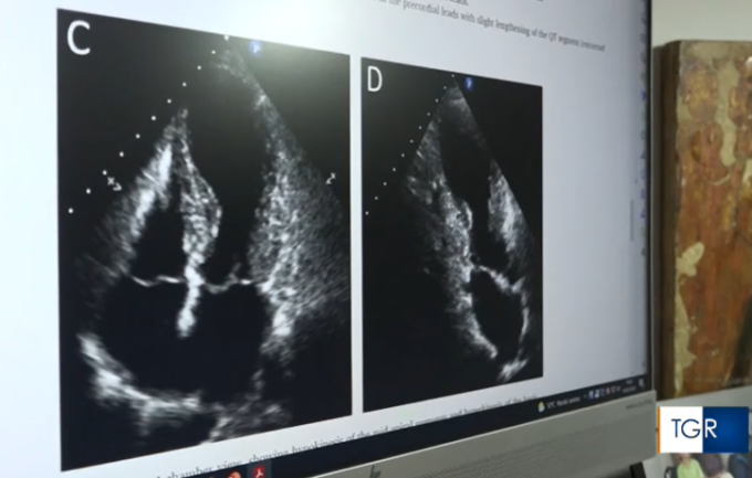 54enne ucraina ricoverata all’ospedale di Lecco: primo caso di “mal di guerra”