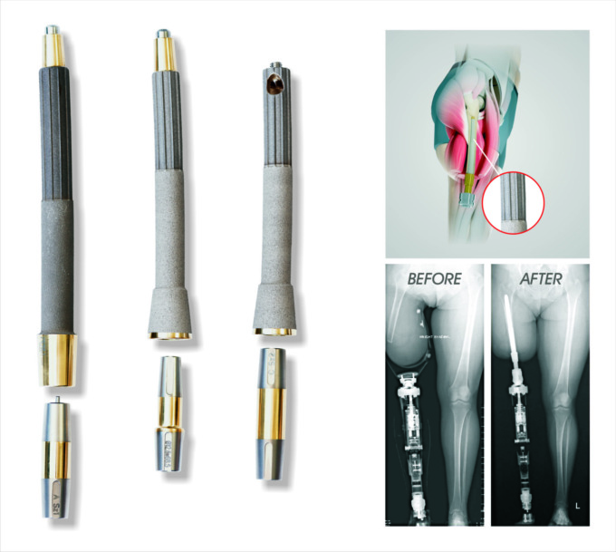 Partnership tra Permedica Orthopaedics di Merate e l’australiana Osseointegration: lanciata in Italia la procedura di osteointegrazione