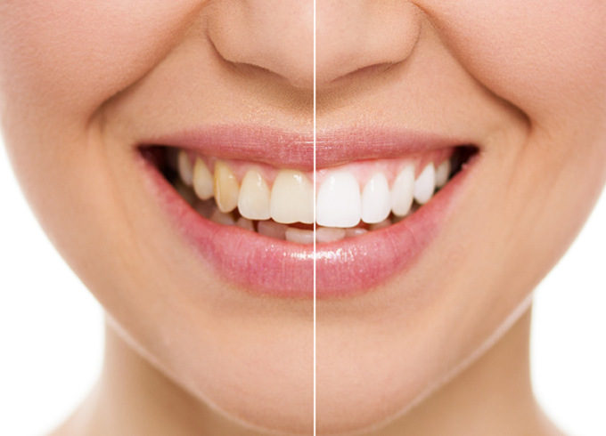 Al «Centro Medico Brianza» l’innovativo metodo che sbianca i denti di otto gradazioni in 45 minuti